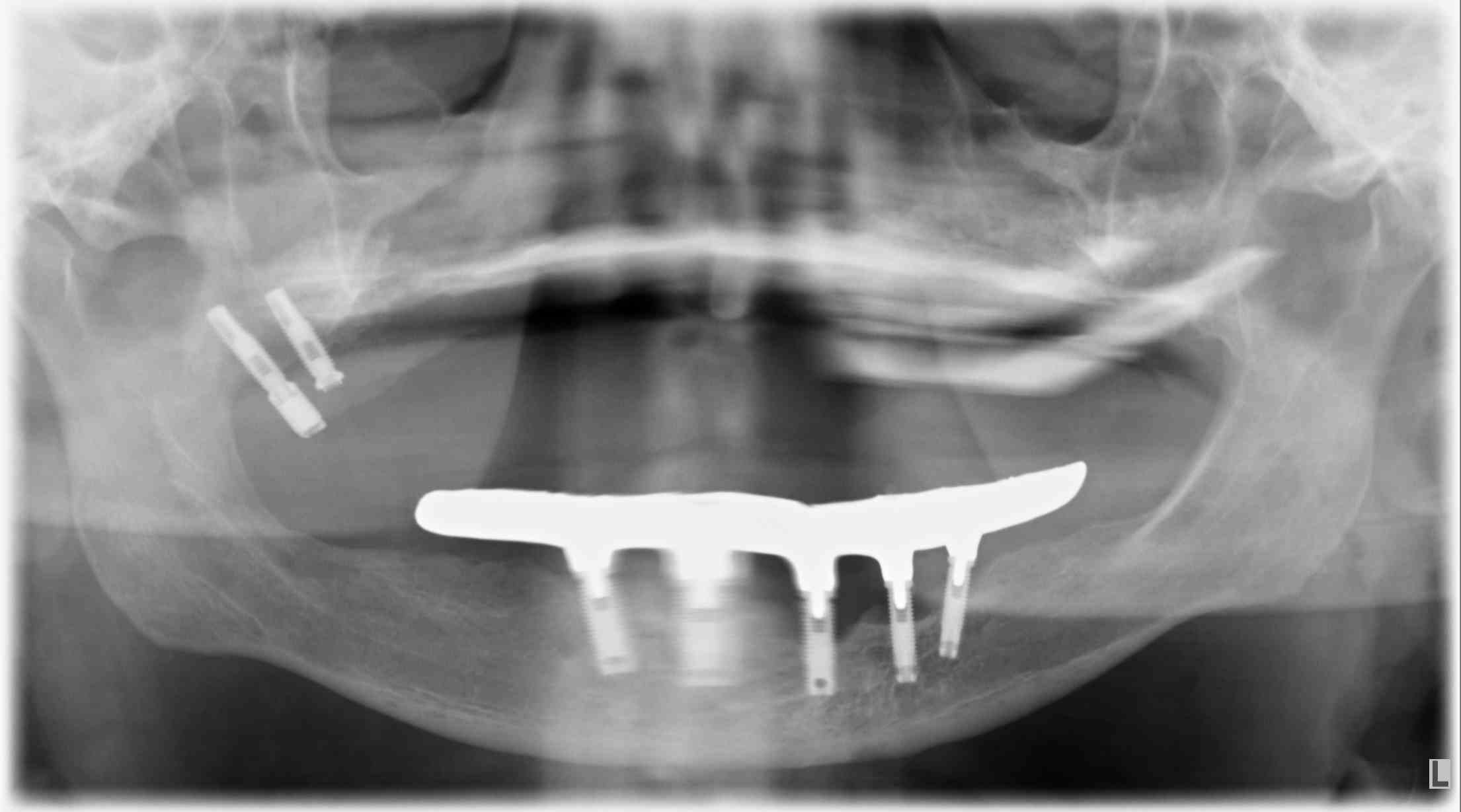 DSS - Caso_Implantes-Subperiosticos-1