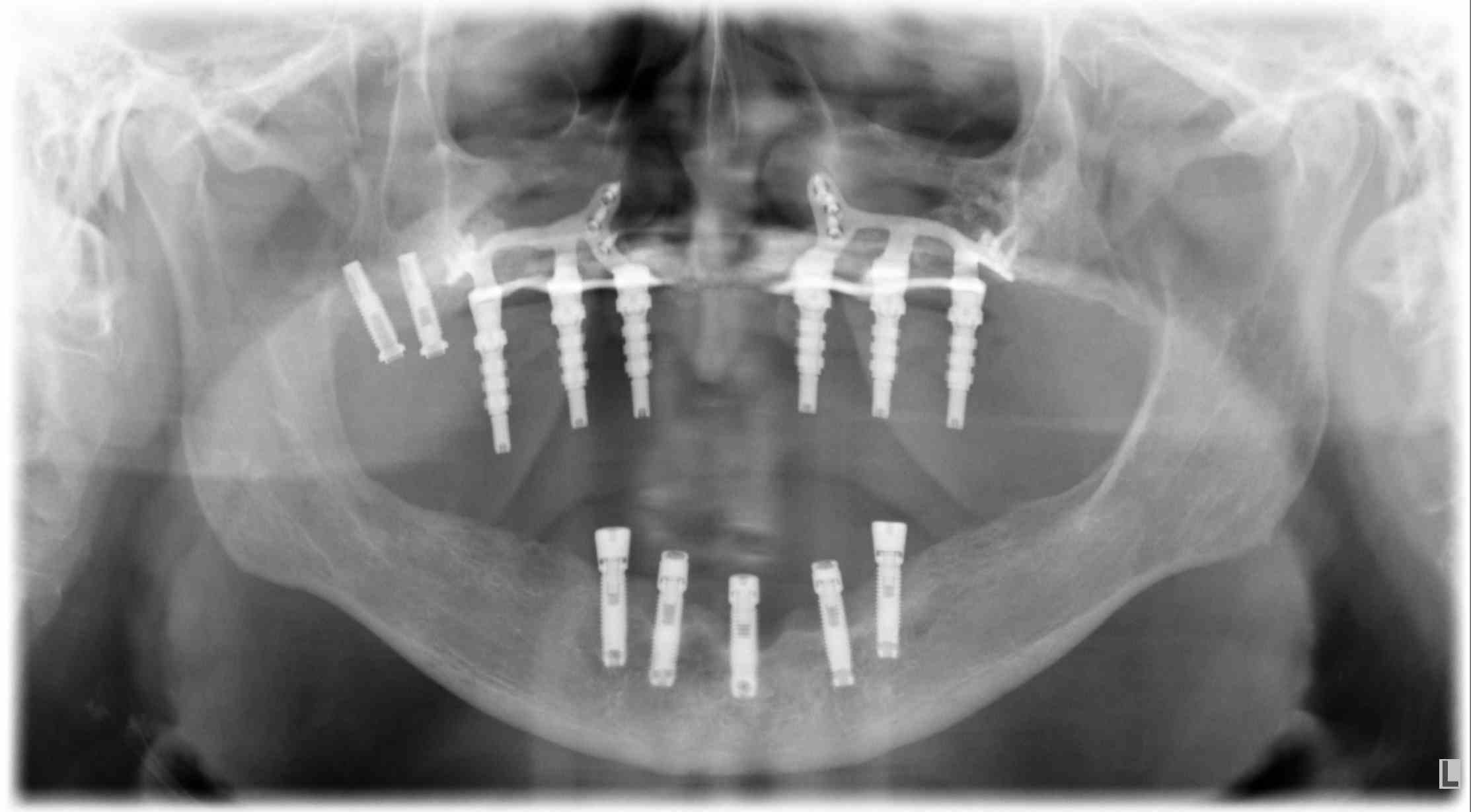DSS - Caso_Implantes-Subperiosticos-2