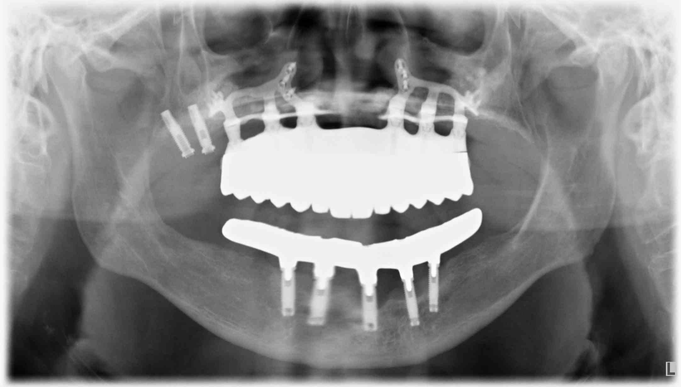 DSS - Caso_Implantes-Subperiosticos-3
