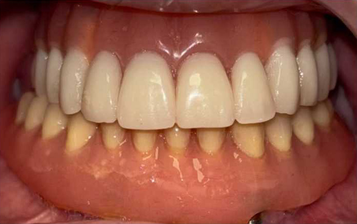 DSS - Caso_Implantes-Subperiosticos-4-1