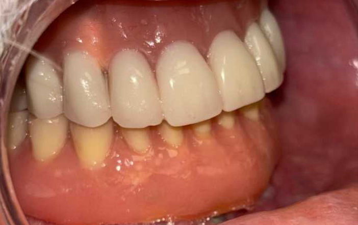 DSS - Caso_Implantes-Subperiosticos-4-2