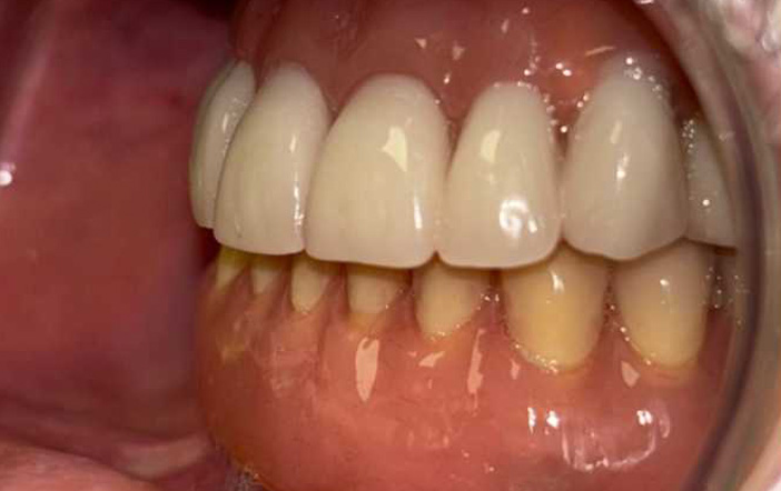 DSS - Caso_Implantes-Subperiosticos-4-3