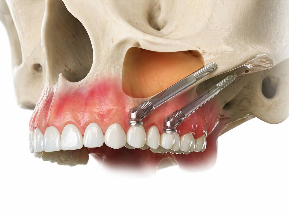 Implantes cigomáticos DSS
