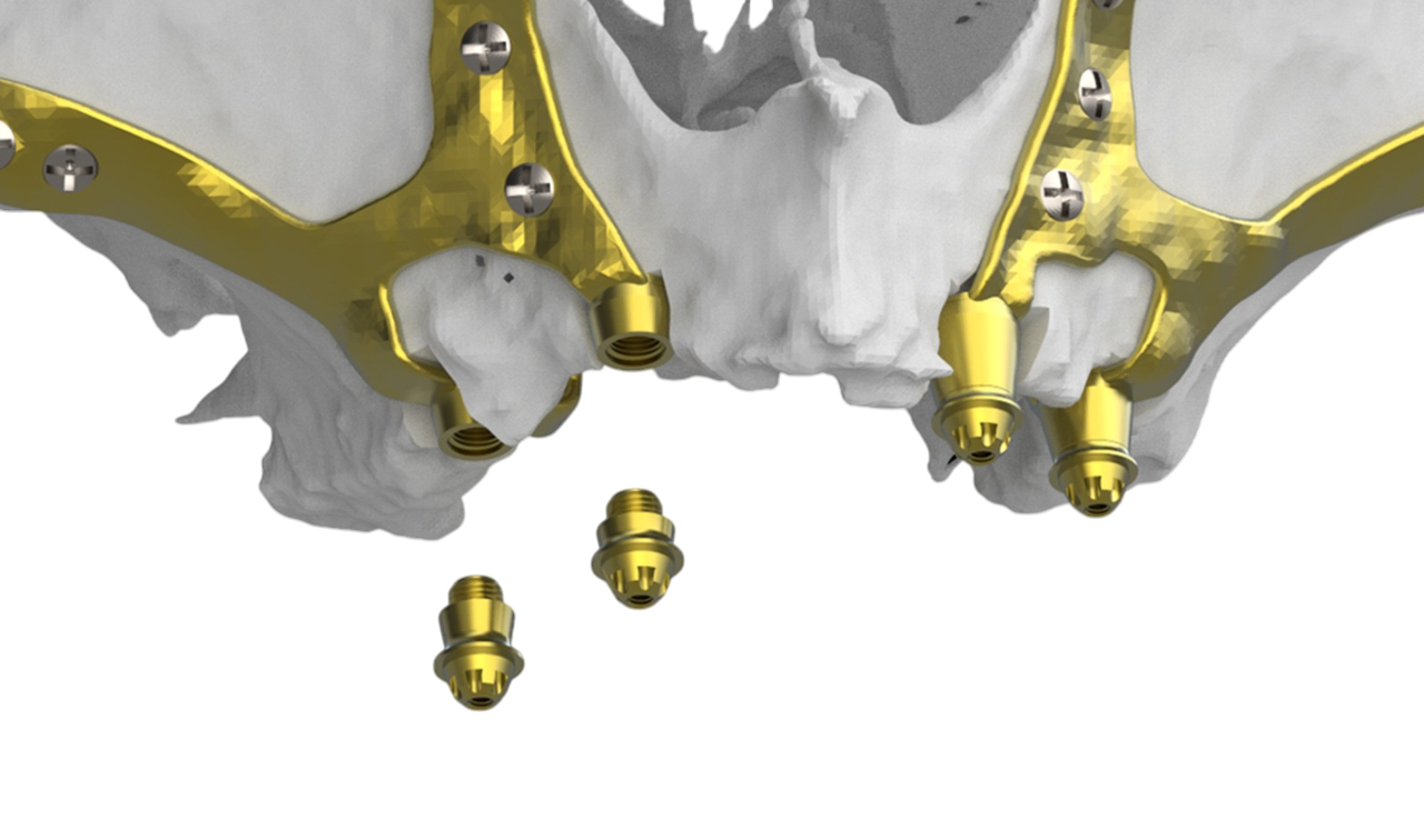 Implantes subperiósticos DSS
