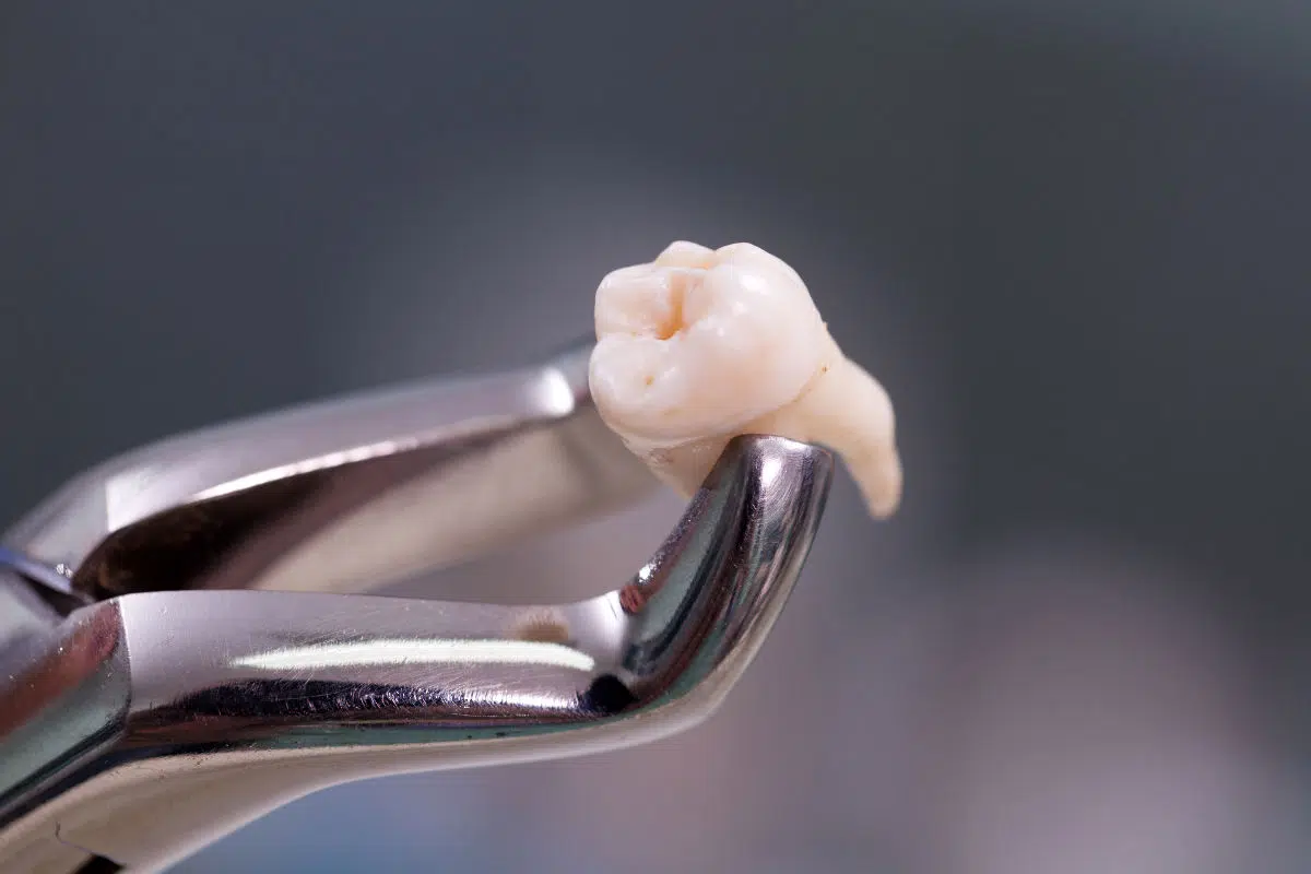 Autotrasplante dental DSS